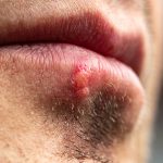 Pimple on lip - Healthy and Better Living