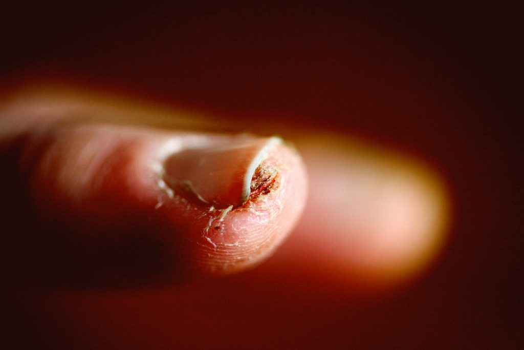 Ingrown fingernail - Healthy & Better Living