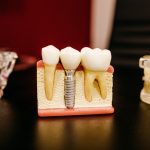 How Long Does a Root Canal Take - Healthy and Better Living